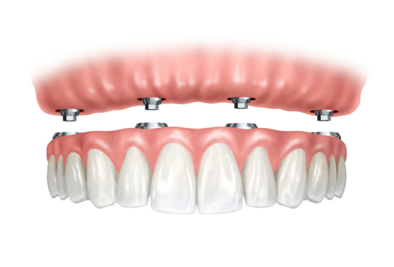 Prótese Dentária 5 Prótese Dentária 5
